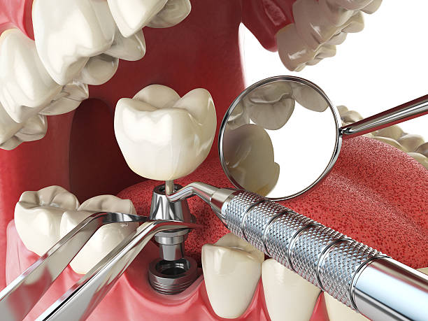 Best Emergency Wisdom Tooth Extraction in Orange, TX